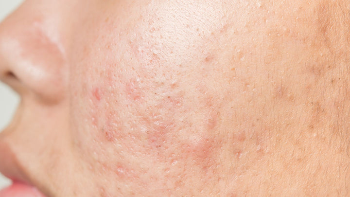 ASK SERUMIZE-What Causes Acne?