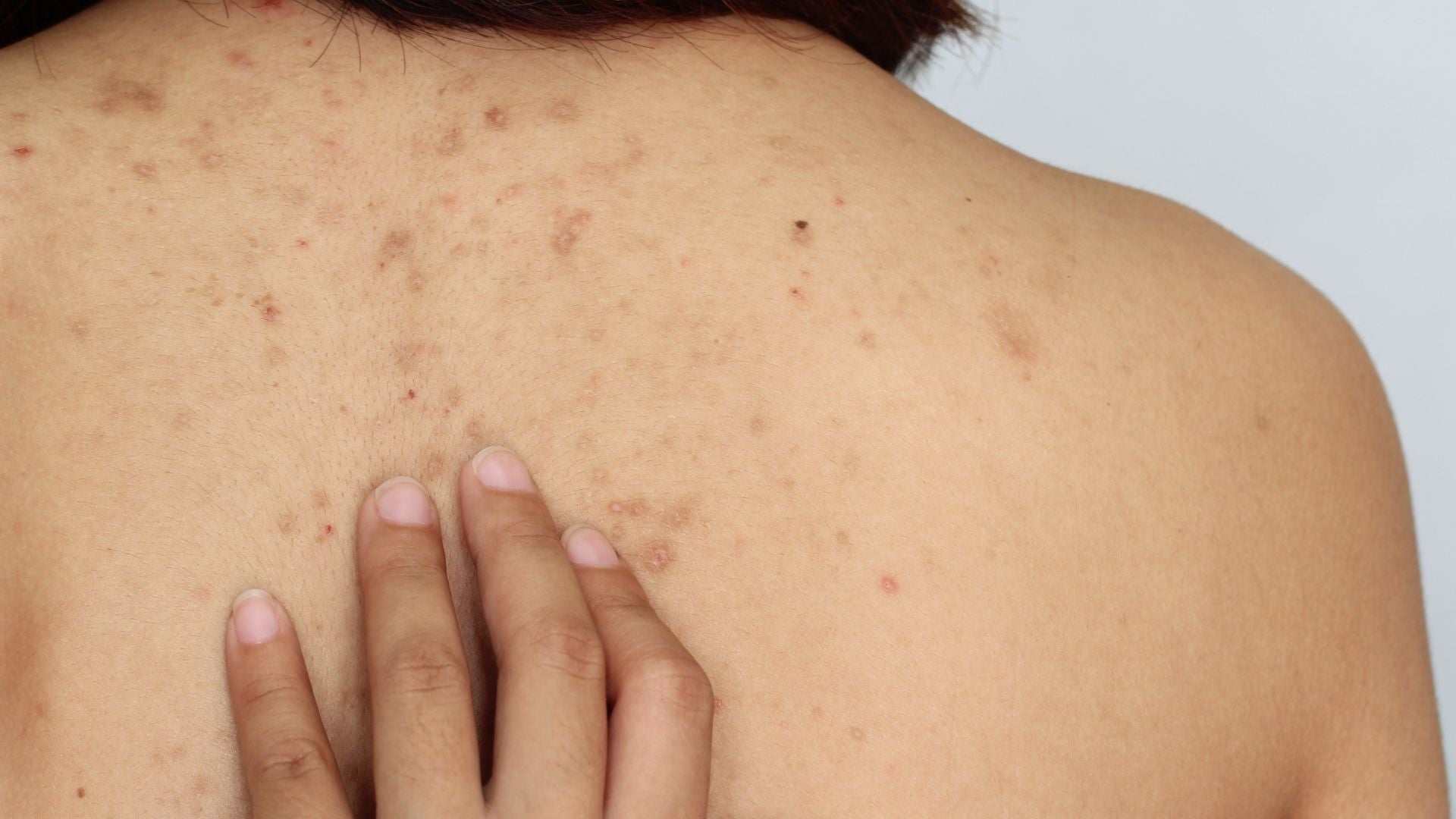 The Truth Behind What Really Causes Bacne and How to Eliminate it ...