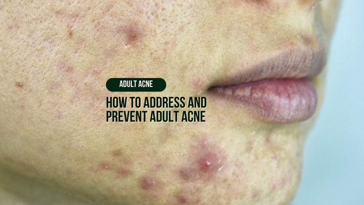 How to Address and Prevent Adult Acne: A Complete Guide