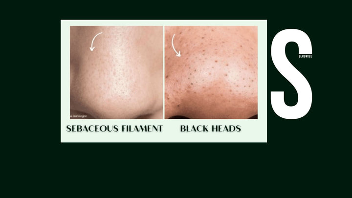 Sebaceous Filaments VS Blackheads: Differences and How to Reduce Them