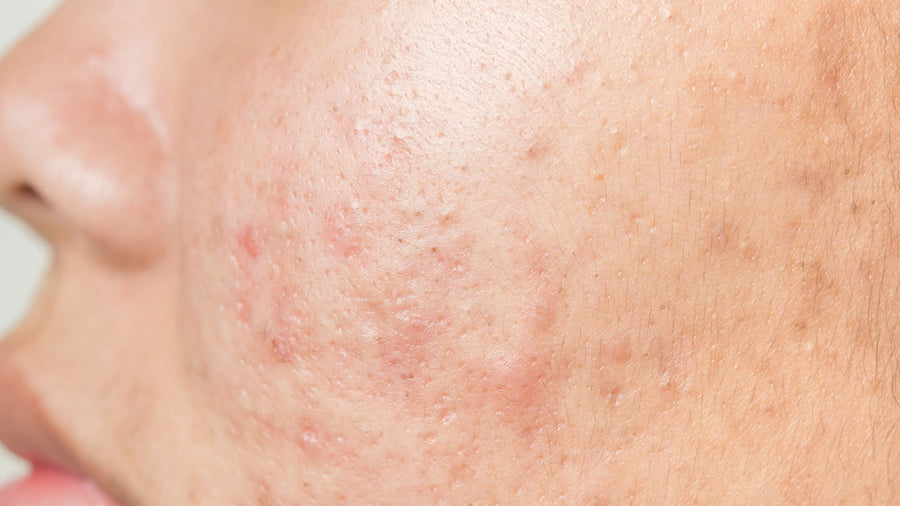 ASK SERUMIZE-What Causes Acne?